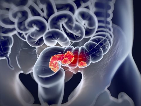 cancer-colorrectal_11zon